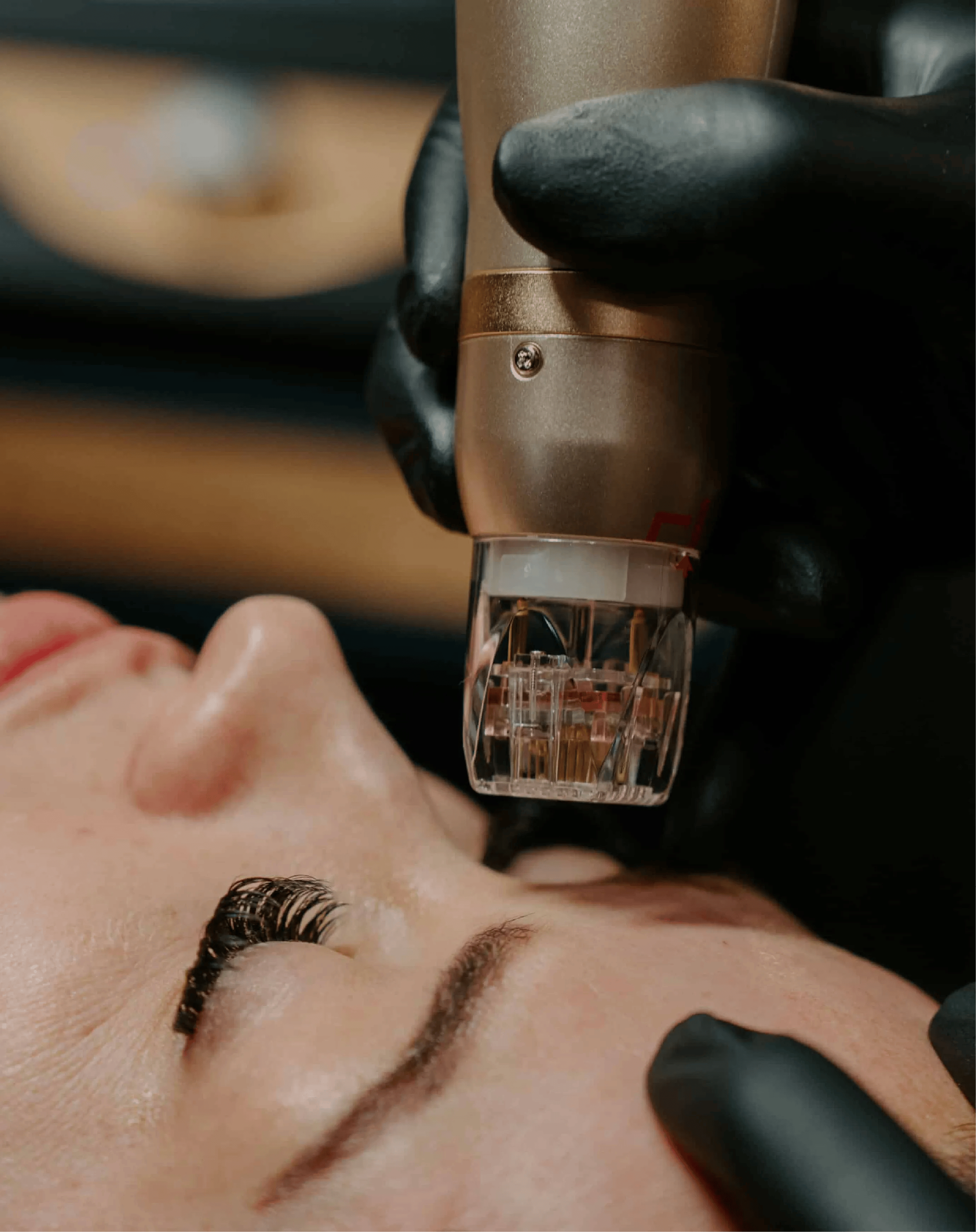 What to expect from RF Microneedling – Sylfirm X treatment at Toronto medical spa - treatment journey